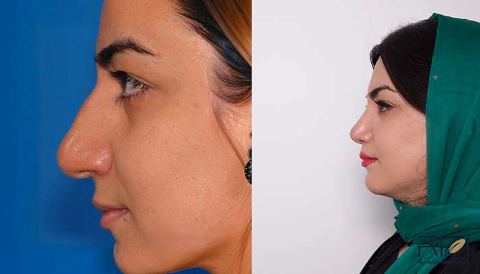 Sample-before-and-after-nose-surgery-9