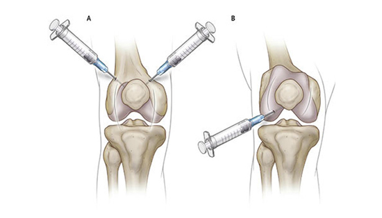 مزایا و معایب تزریق ژل به زانو