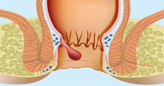 بهترین روش درمان شقاق مقعدی