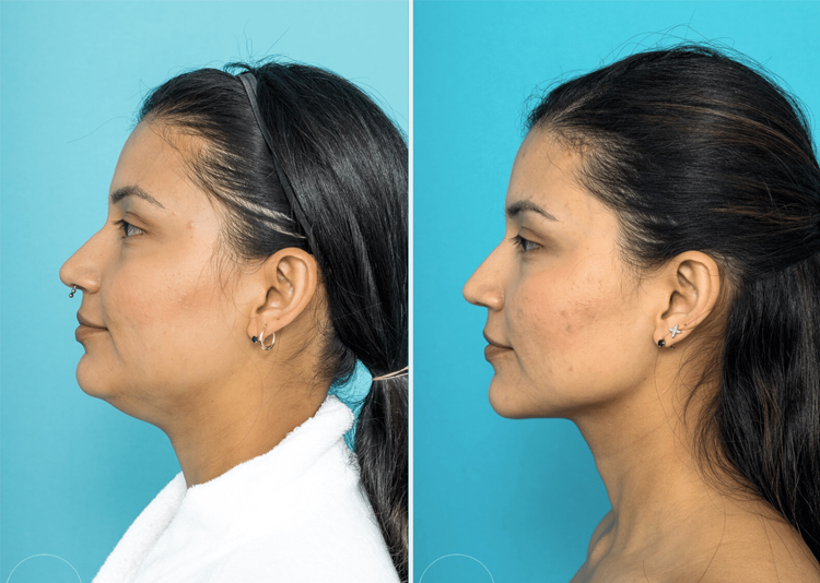 عوارض بعد از عمل ساکشن غبغب