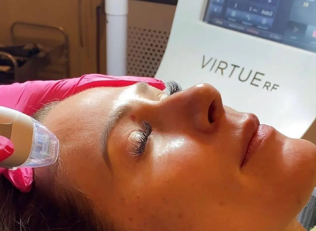 لیفت صورت با دستگاه Virtue RF چگونه انجام می‌شود؟