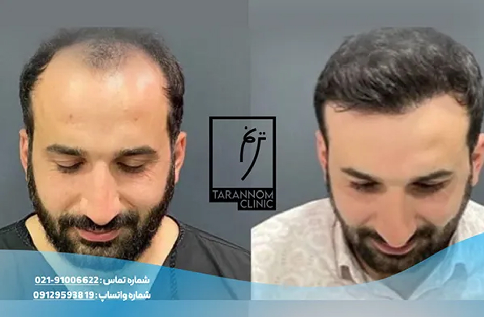 کلینیک کاشت مو ترنم