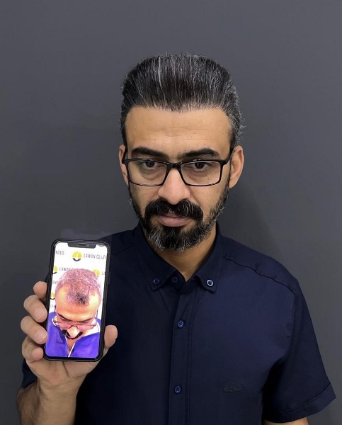 نمونه کاشت مو - کلینیک پارسیان
