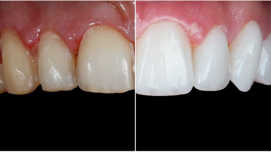 لمینت بدون آماده‌سازی (No-Prep Veneers)