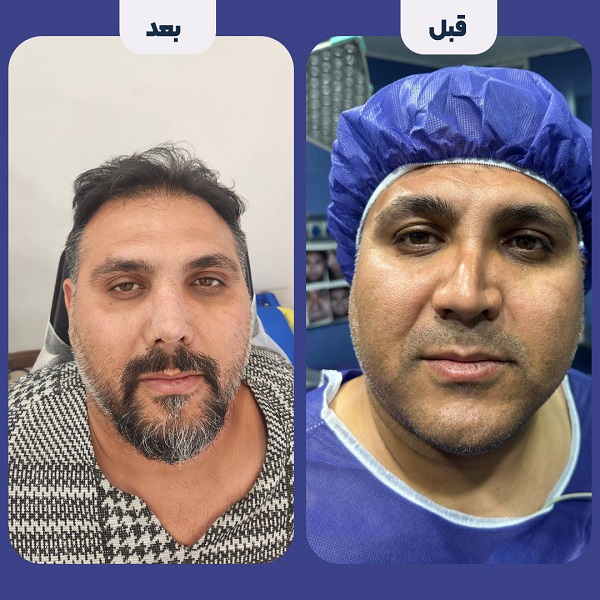نمونه جراحی بینی دکتر محمد لاجوردی