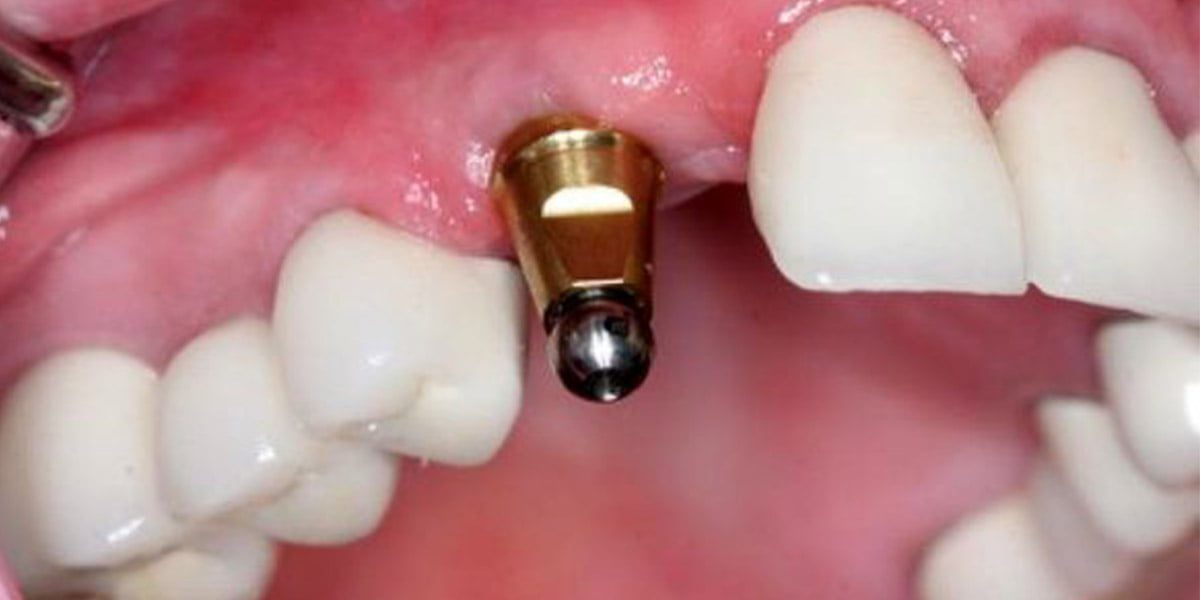 روش fresh socket