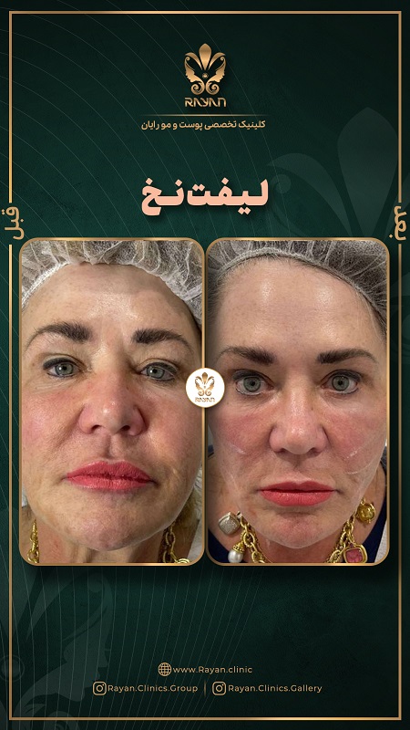 لیفت صورت با نخ - کلینیک رایان سلامت
