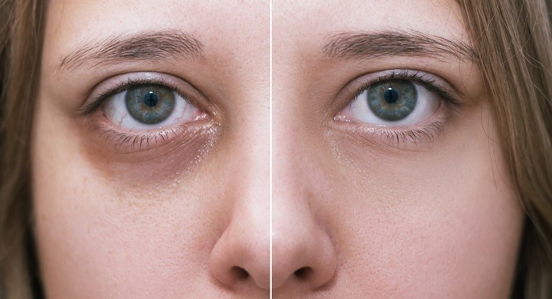 درمان سریع گودی زیر چشم با PRF