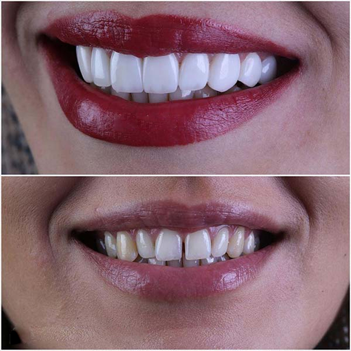 لمبنت بلند و برجسته