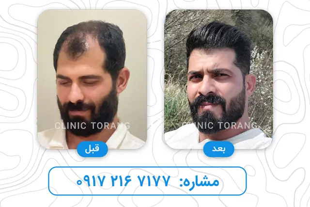 kashtshiraz-before-after