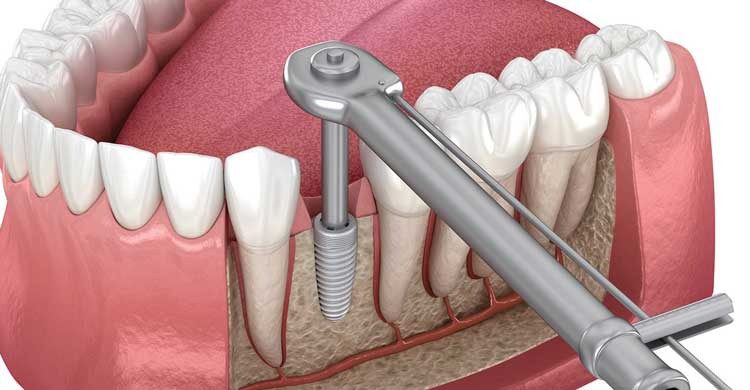 implant-screw