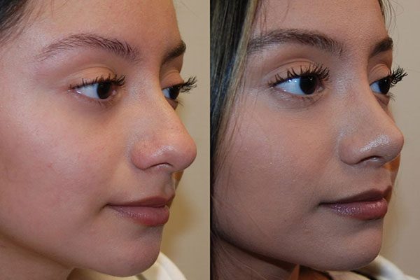 جراحی طبیعی بینی