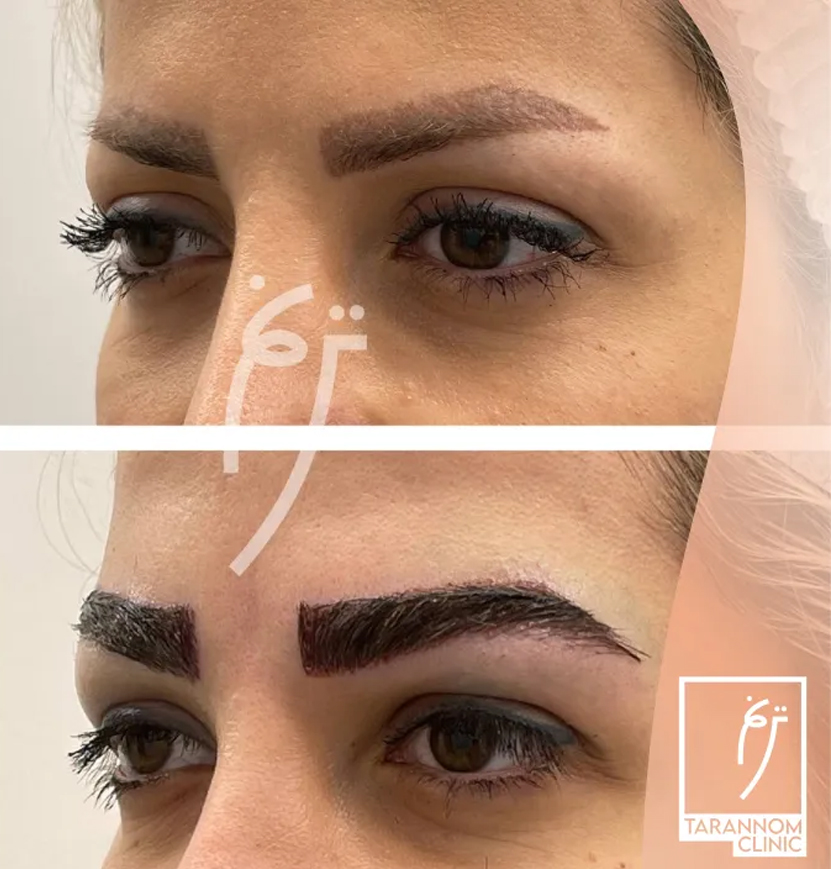 کلینیک کاشت ابرو ترنم