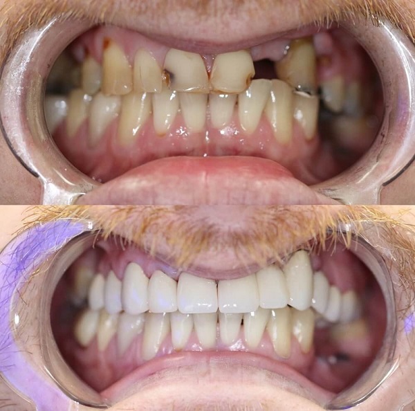 مراحل ایمپلنت دندان و مدت زمان انجام آن