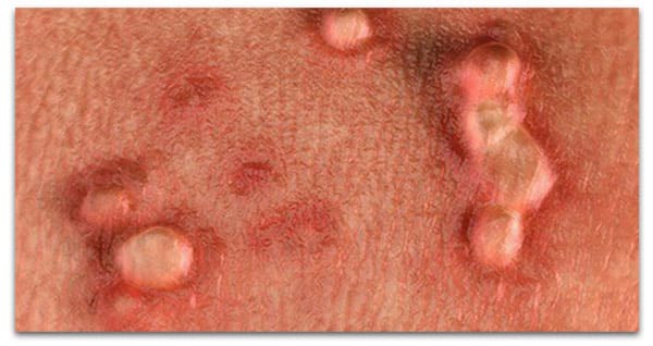 زگیل تناسلی