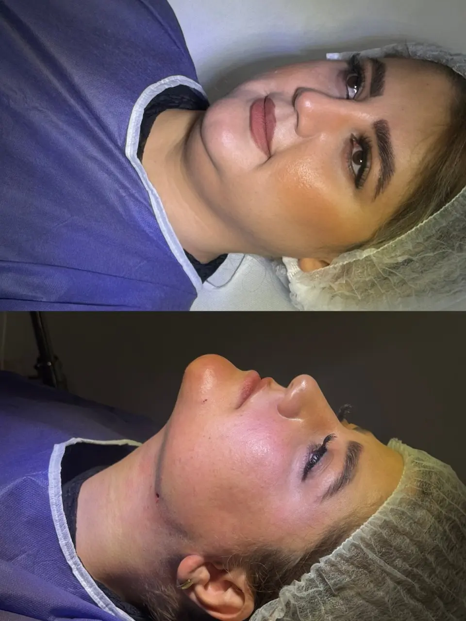 ساکشن غبغب (2)