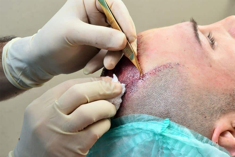 کاشت مو با لیزر با چه تکنیک هایی انجام می شود؟