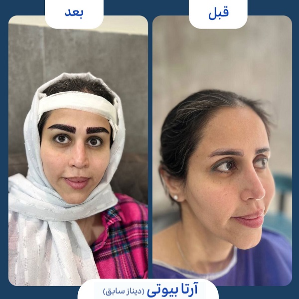 نمونه قبل و بعد کاشت ابرو کلینیک آرتا بیوتی