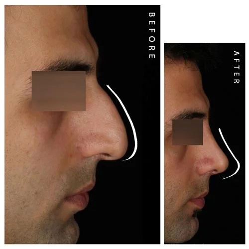 نمونه جراحی بینی استخوانی - کلینیک پارتا