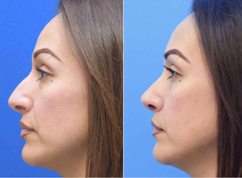 Nose-Surgery-6