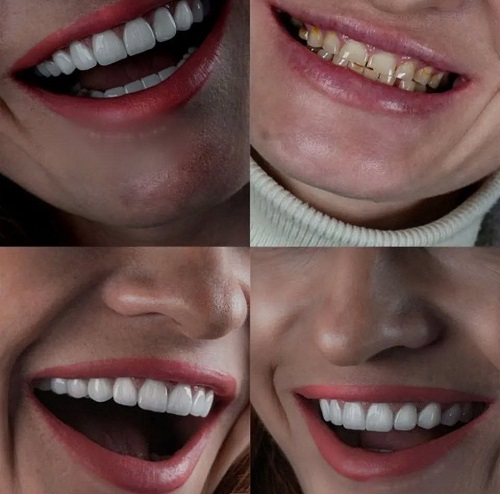 نمونه های کامپوزیت دندان دکتر علی ممتازی