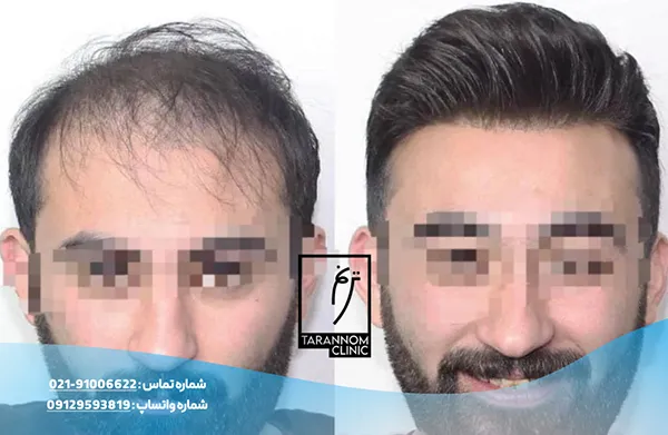 hair-transplant-portfolio-9