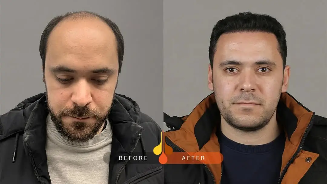 hair-transplant-before-after-8