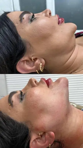 ساکشن غبغب در کلینیک آرتان