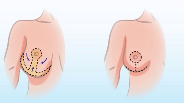 جراحی کوچک کردن سینه یا  ماموپلاستی (Mammoplasty) چیست و چه انواعی دارد؟