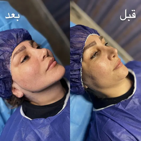 نمونه تزریق ژل گونه در کلینیک آلیما