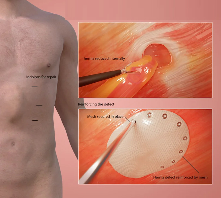 بهترین روش درمان فتق چیست؟