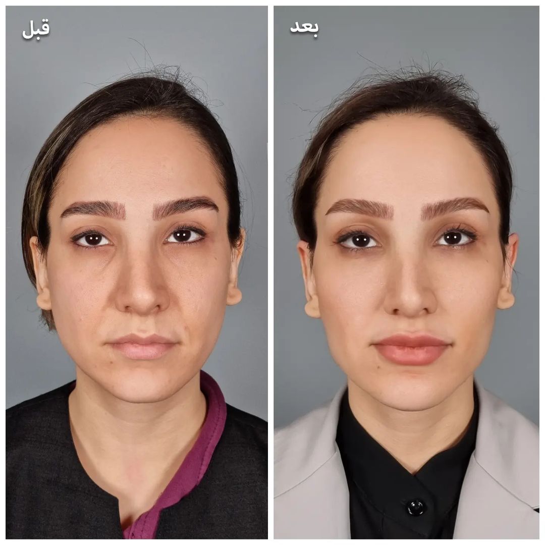 عکس-قبل-و-بعد-فیلر-گونه-و-خط-خنده3