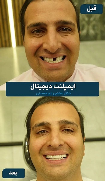 نمونه ایمپلنت دندان در دندانپزشکی هومینا