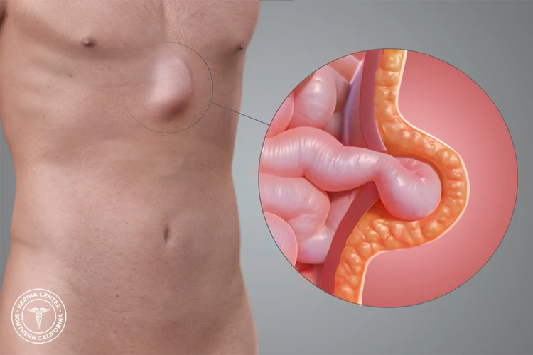 فتق اپی گاستریک