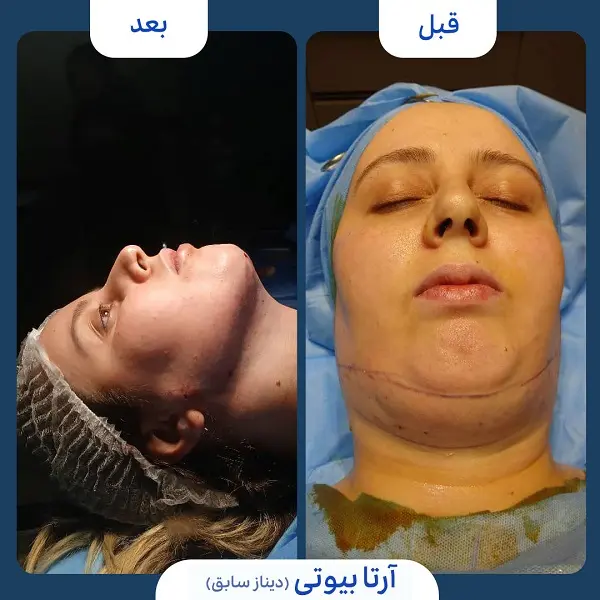 نمونه قبل و بعد جراحی غبغب کلینیک آرتا بیوتی