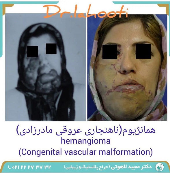 نمونه جراحی ترمیم صورت توسط دکتر مجید لاهوتی