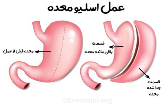 بهترین جراحی لاغری را بشناسید