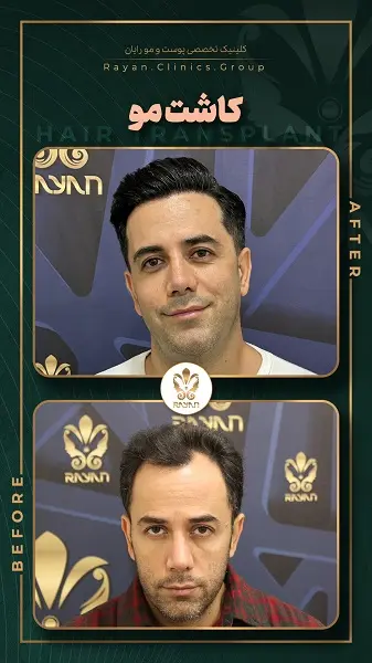 نمونه قبل و بعد جراحی پیوند مو در کلینیک رایان سلامت