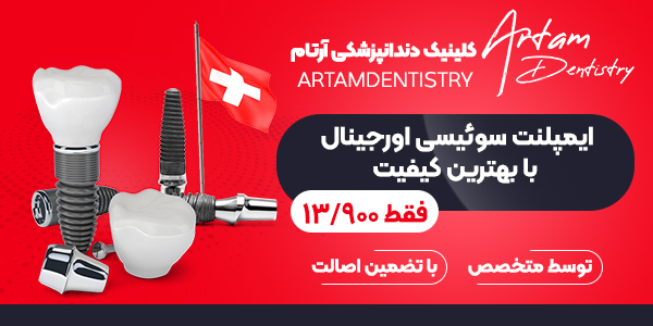 مراحل ایمپلنت دندان و مدت زمان انجام آن