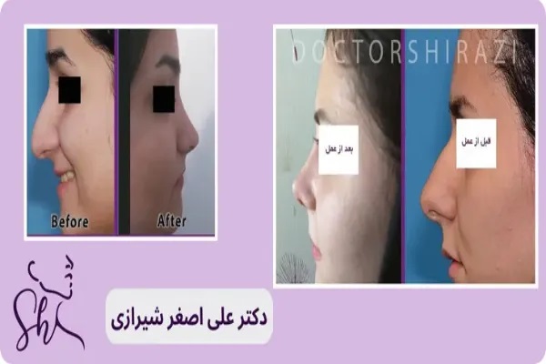 نمونه جراحی بینی گوشتی دوم - دکتر علی اصغر شیرازی