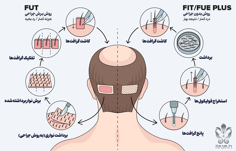 روش های کاشت مو
