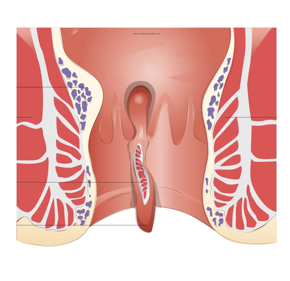 fissure