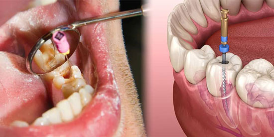 علائم عفونت ریشه دندان چیست؟