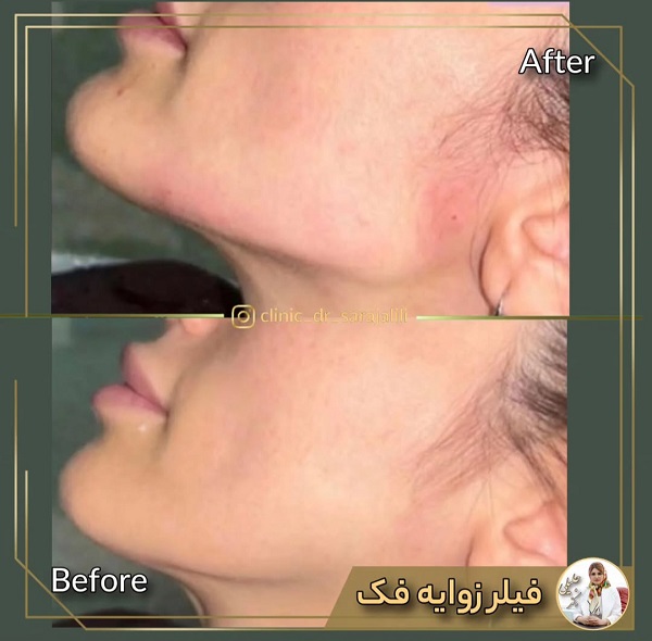 نمونه کانتورینگ صورت - دکتر سارا جلیلی