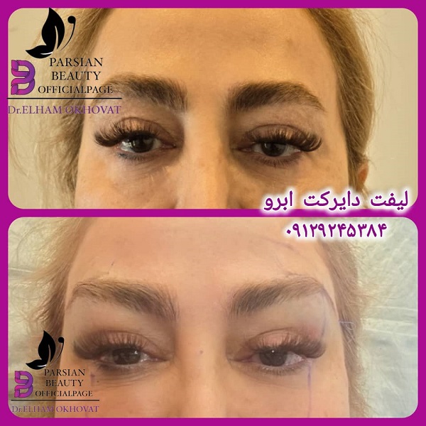 لیفت ابرو و شقیقه کلینیک زیبایی پارسیان