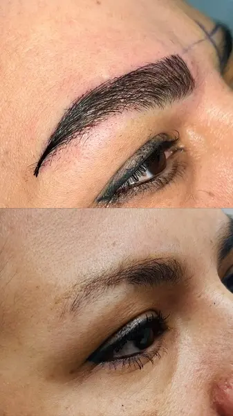 نمونه کاشت ابرو در کلینیک آرتان