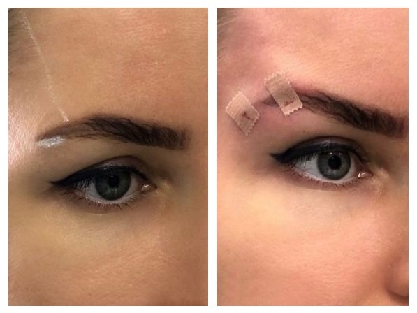 لیفت پلک با نخ