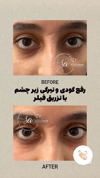 نمونه تزریق مزوژل - دکتر سوسن احمدی