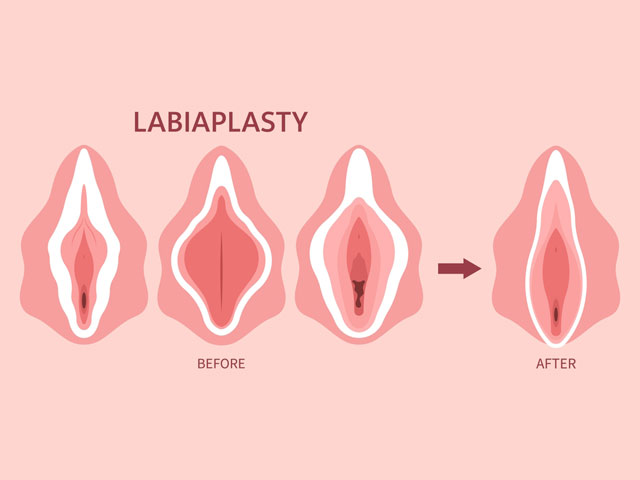 Labiaplasty