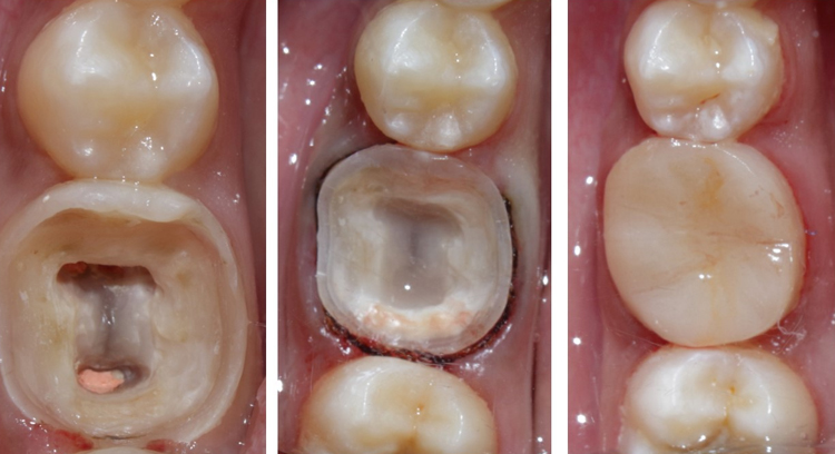 مزایای اندوکراون
